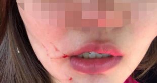 Nữ tiếp viên Đ.K.H. bị chấn thương phần mềm, tinh thần hoảng loạn